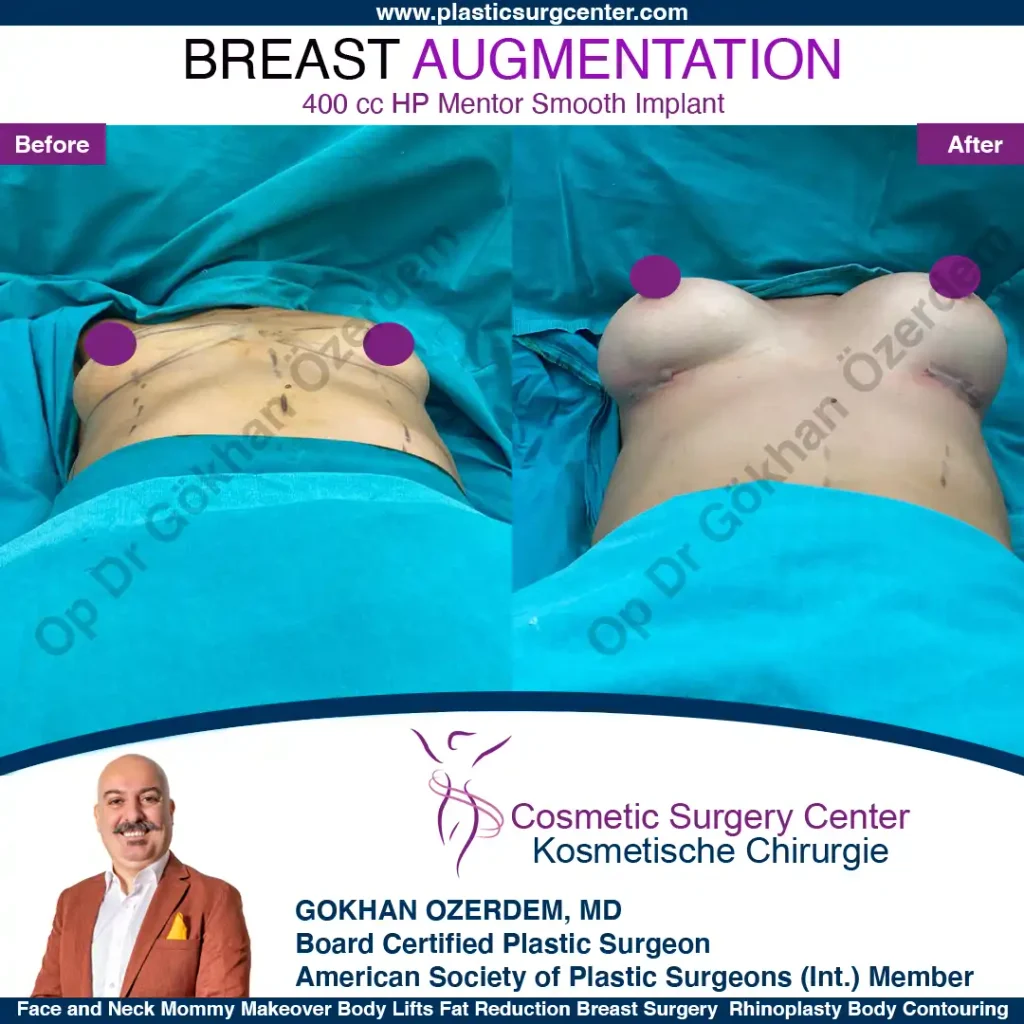 Breast Augmentation in Turkey - Case 25 - Front Side