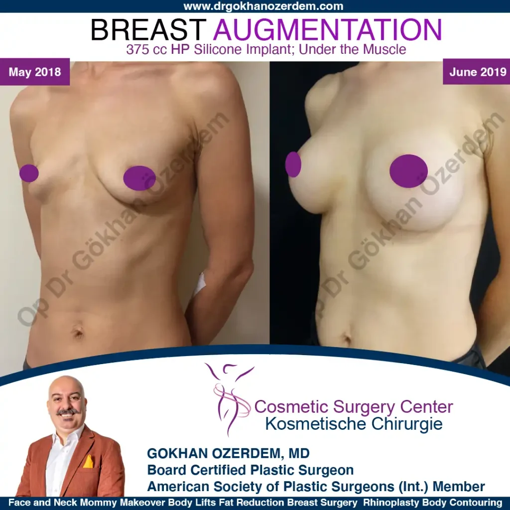 Breast Augmentation in Turkey - Case 12 - Oblique View