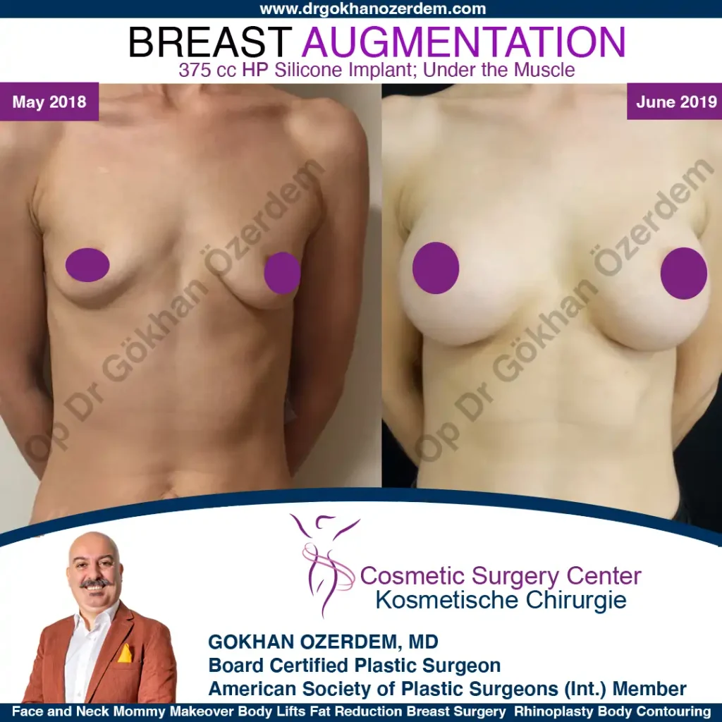 Breast Augmentation in Turkey - Case 12 - Front View