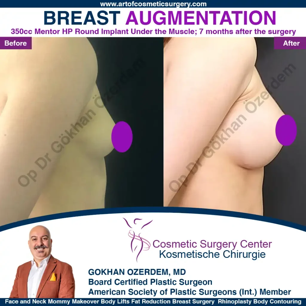 Breast Augmentation in Turkey - Case 35 - Right Side