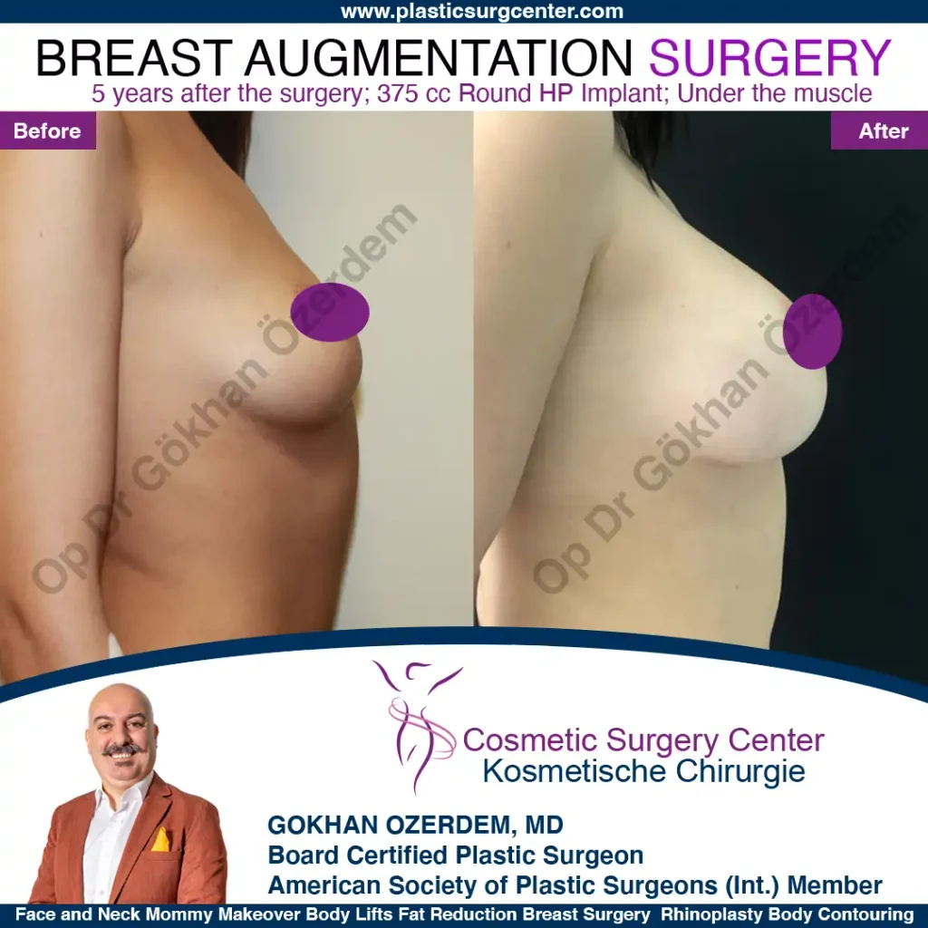Breast Augmentation in Turkey - Case 11 - Right Side