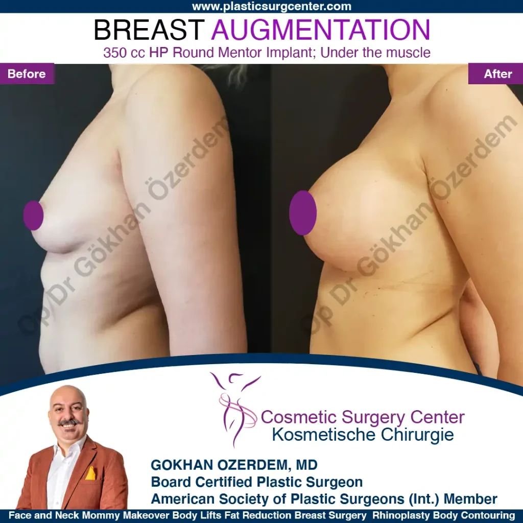 Breast Augmentation in Turkey - Case 10 - Left Side