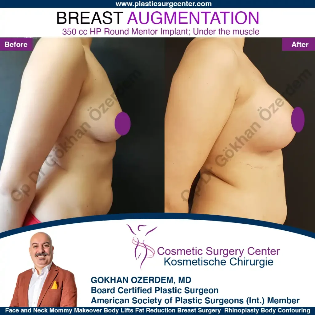 Breast Augmentation in Turkey - Case 10 - Right Side