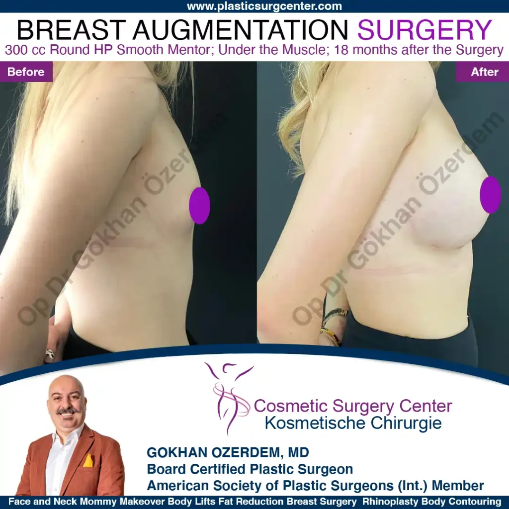Breast Augmentation in Turkey - Case 32 - Right View