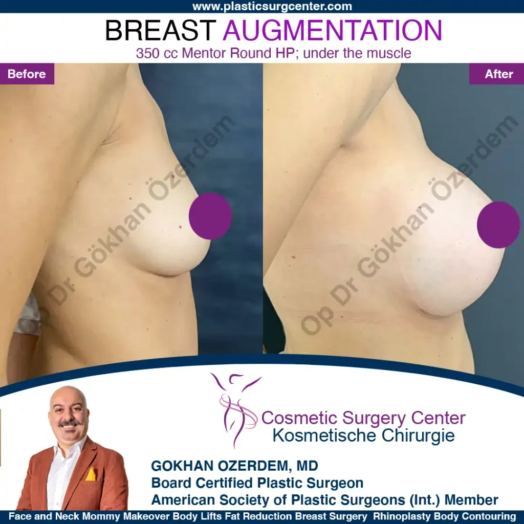 Breast Augmentation in Turkey - Case 9 - Right Side