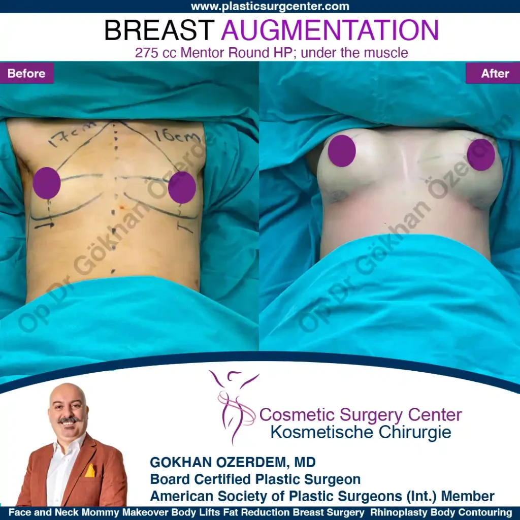 Breast Augmentation in Turkey - Case 21 - Front Side