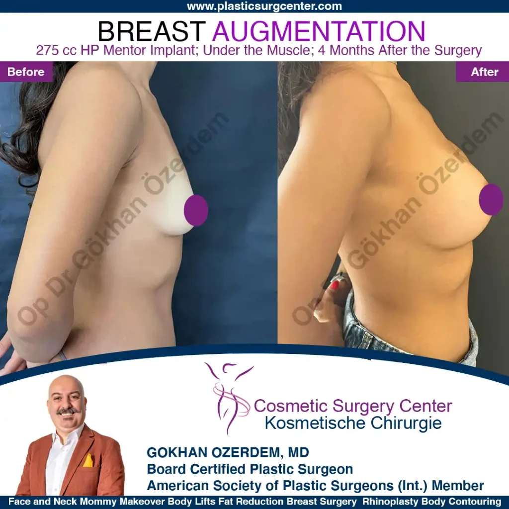 Breast Augmentation in Turkey - Case 8 - Right Side