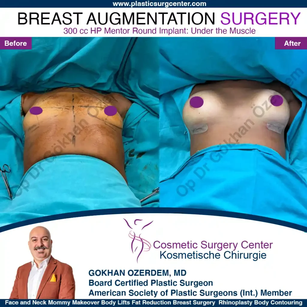 Breast Augmentation in Turkey - Case 20 - Front Side