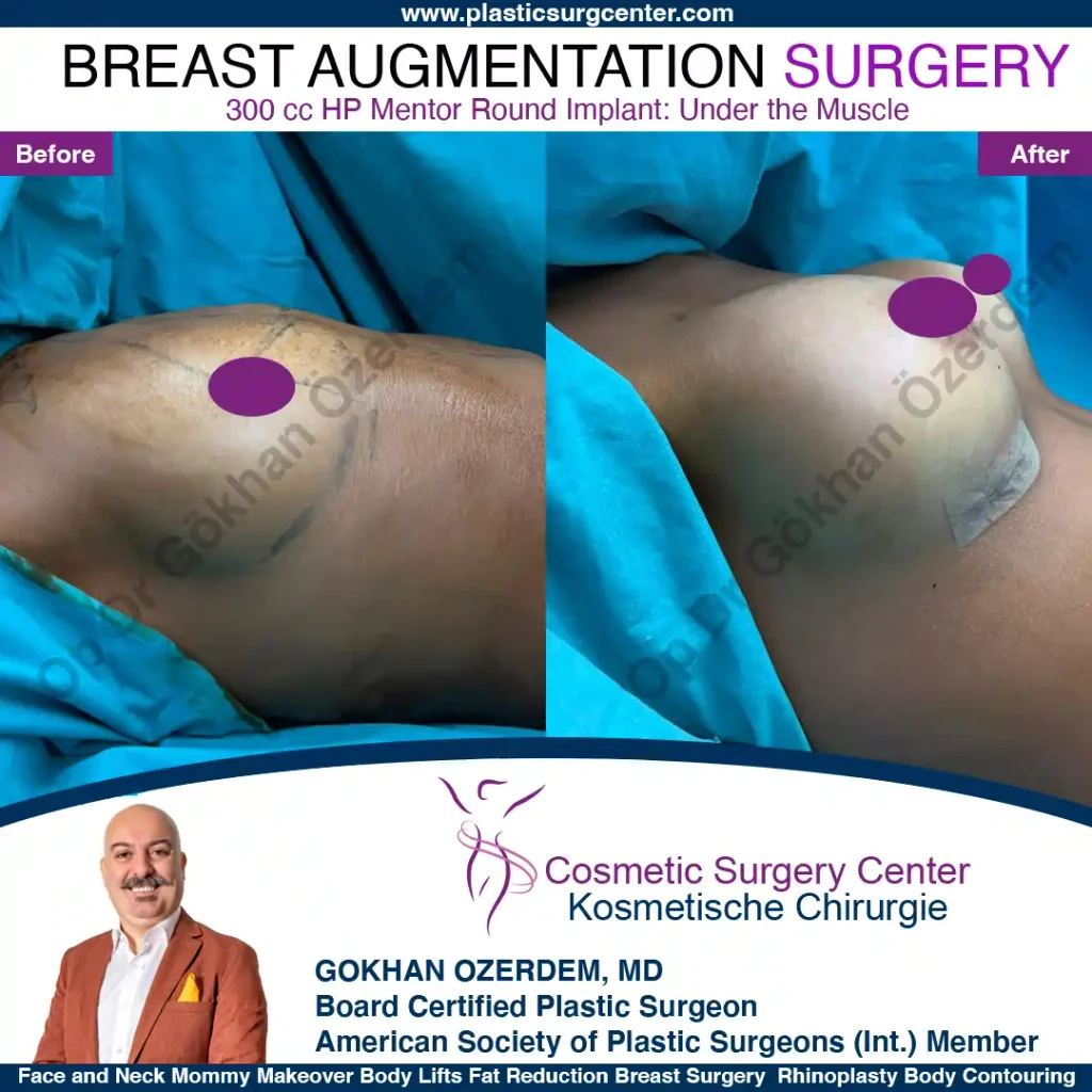 Breast Augmentation in Turkey - Case 19 - Right Side