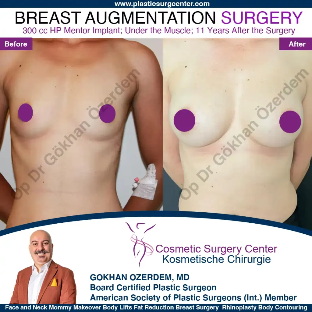 Breast Augmentation in Turkey - Case 7 - Front View