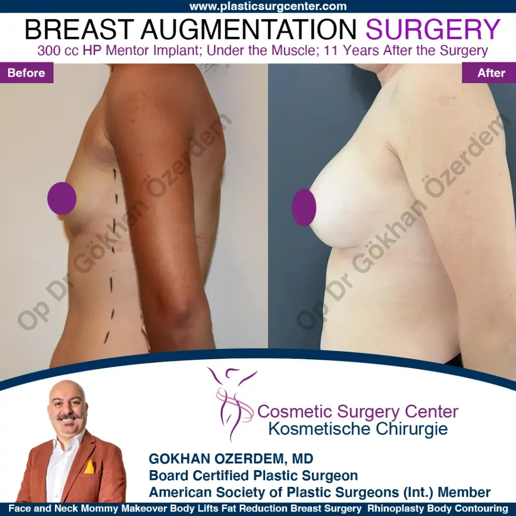 Breast Augmentation in Turkey - Case 7 - Left Side