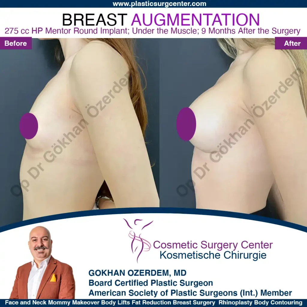 Breast Augmentation in Turkey - Case 6 - Left Side