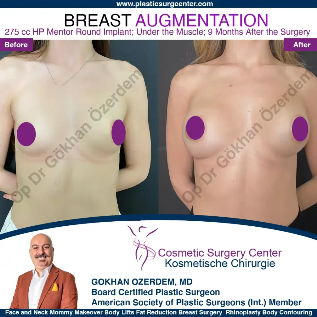 Breast Augmentation in Turkey - Case 6 - Front View