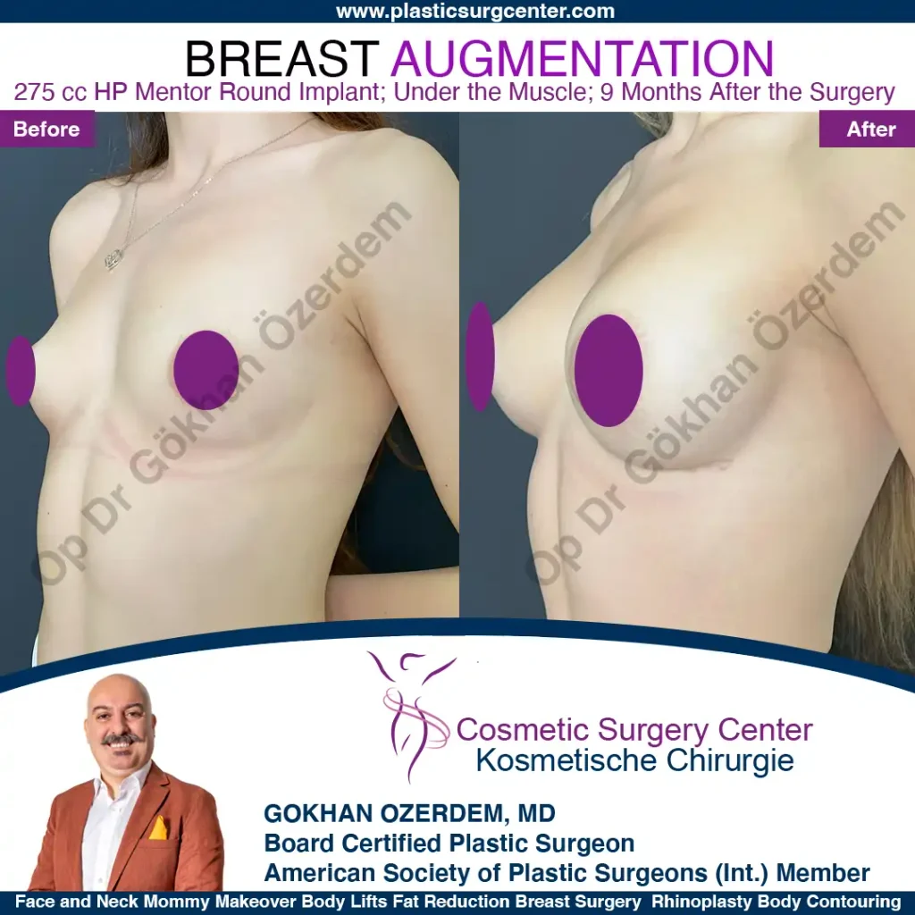 Breast Augmentation in Turkey - Case 6 - Oblique View