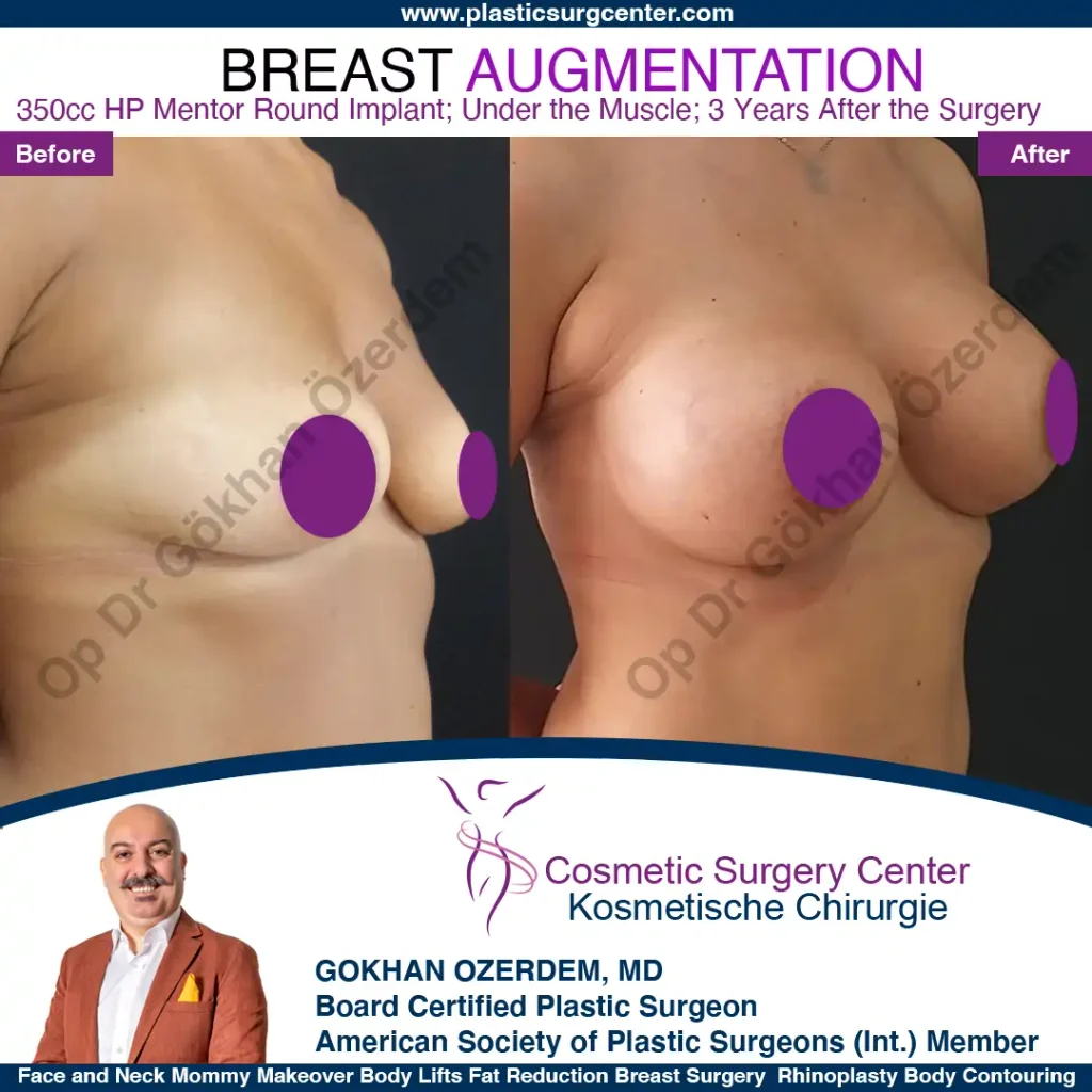 Breast Augmentation in Turkey - Case 5 - Oblique View