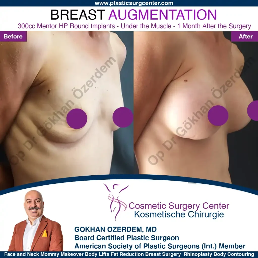 Breast Augmentation in Turkey - Case 4 - Oblique View