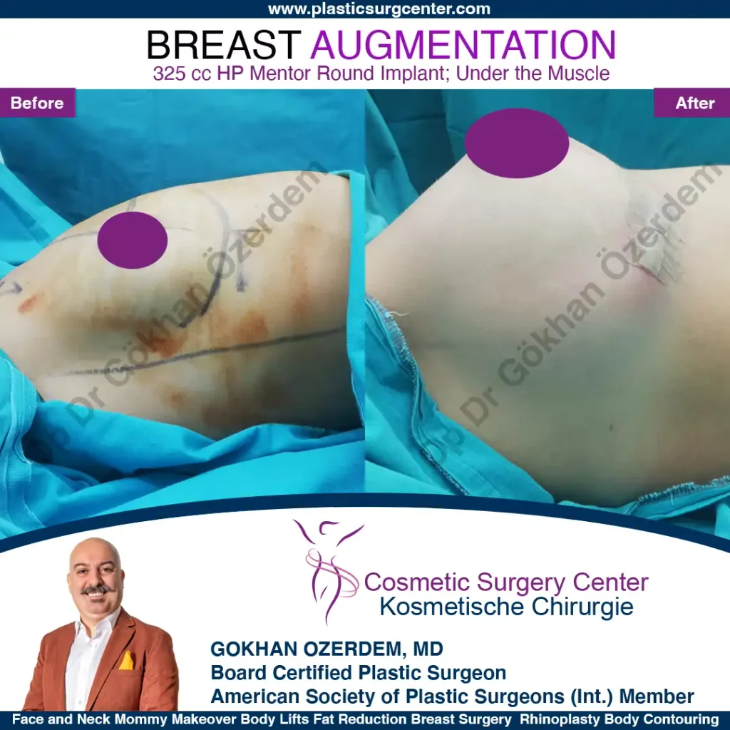 Breast Augmentation in Turkey - Case 18 - Right Side