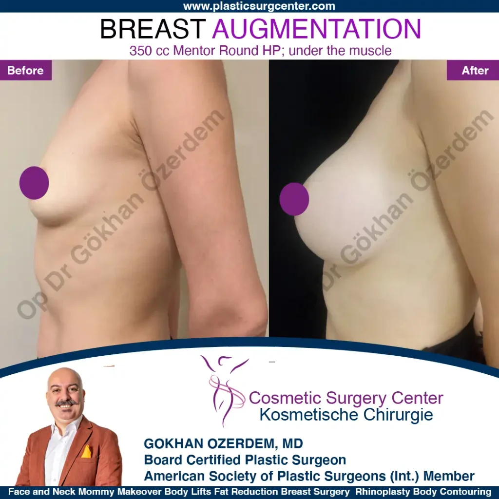 Breast Augmentation in Turkey - Case 3 - Left Side
