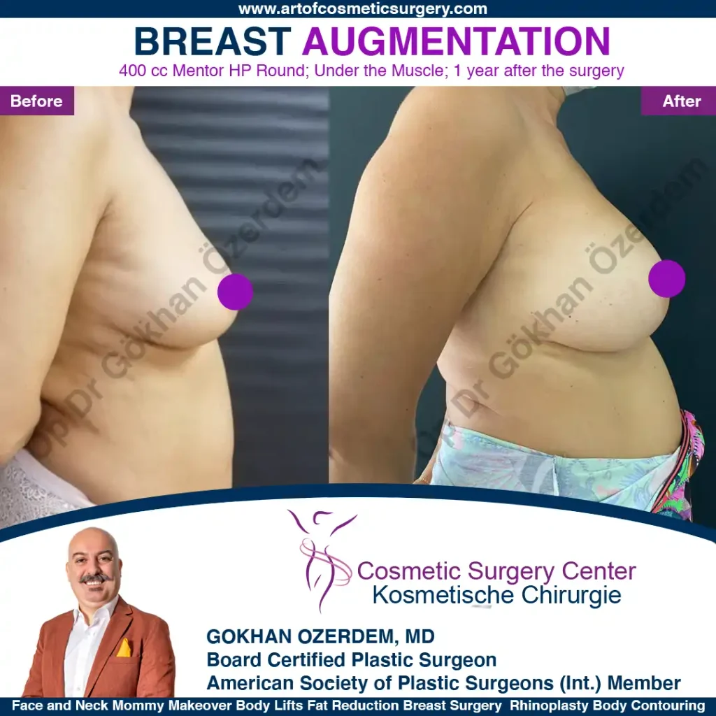 Breast Augmentation in Turkey - Case 31 - Right View