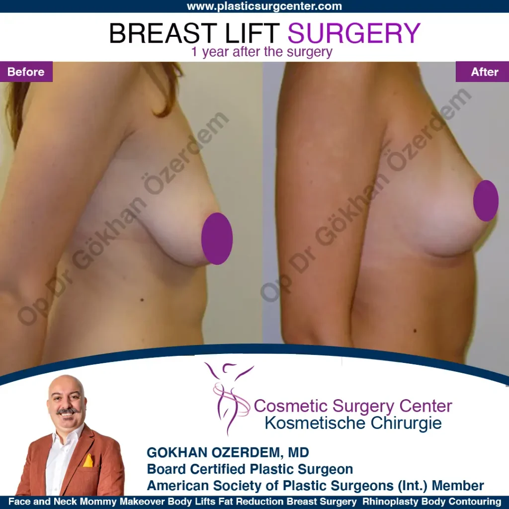 Breast Lift in Turkey, Case 10 - Right Oblique View