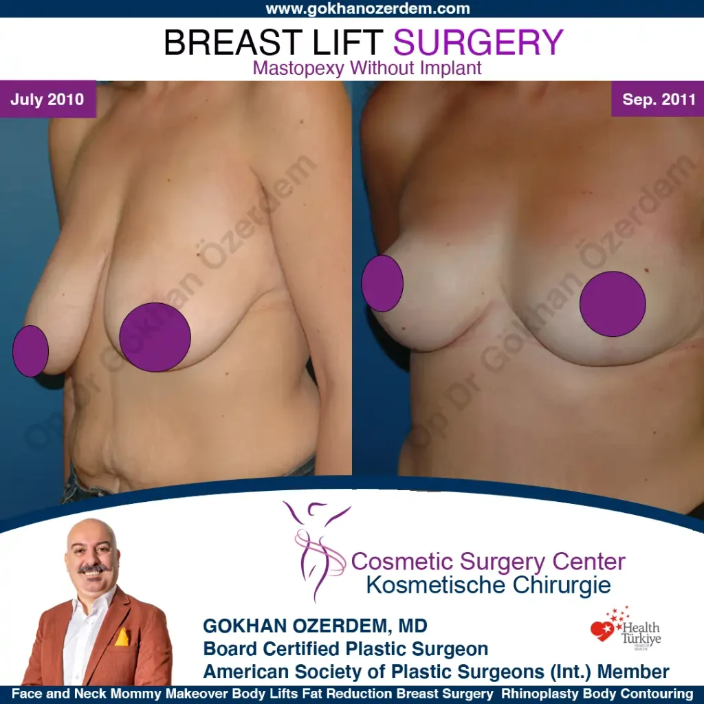 Breast Lift in Turkey, Case 23- Obique View
