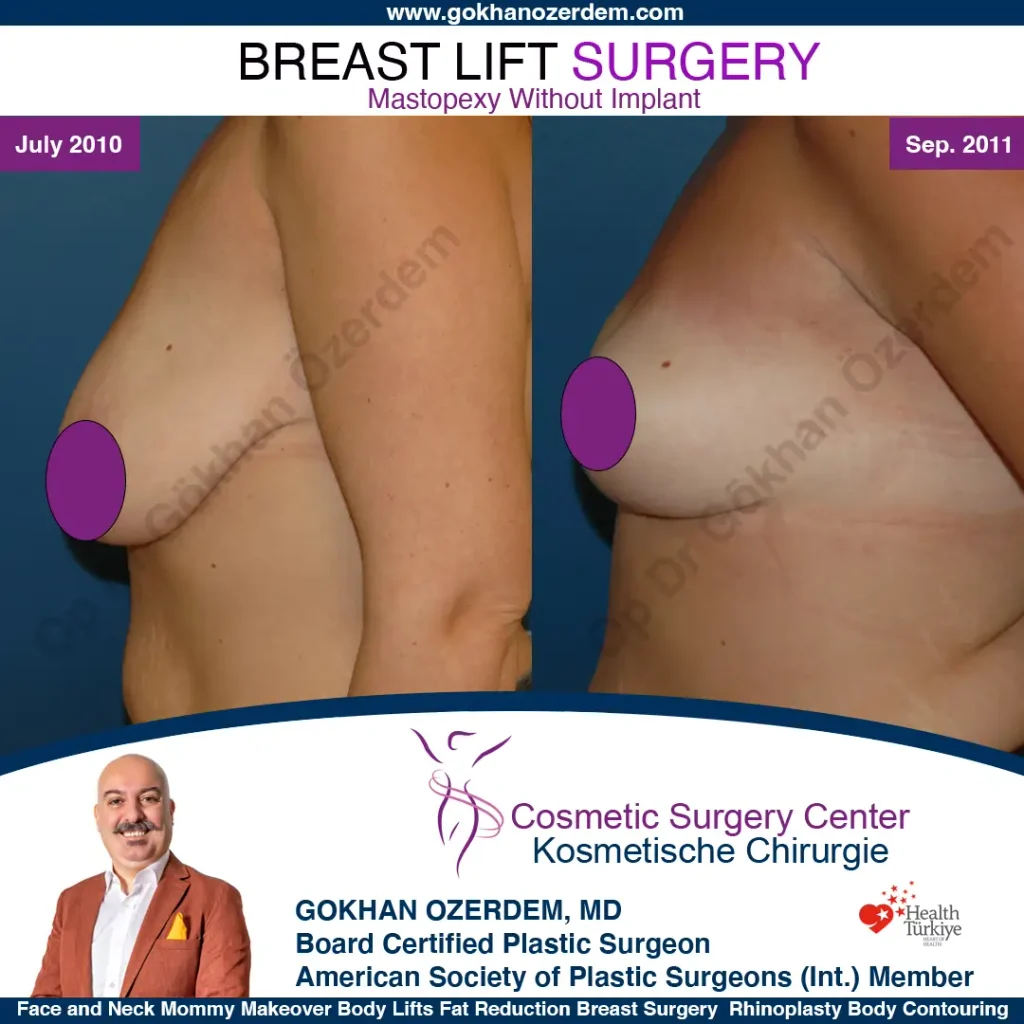 Breast Lift in Turkey, Case 23- Left Side