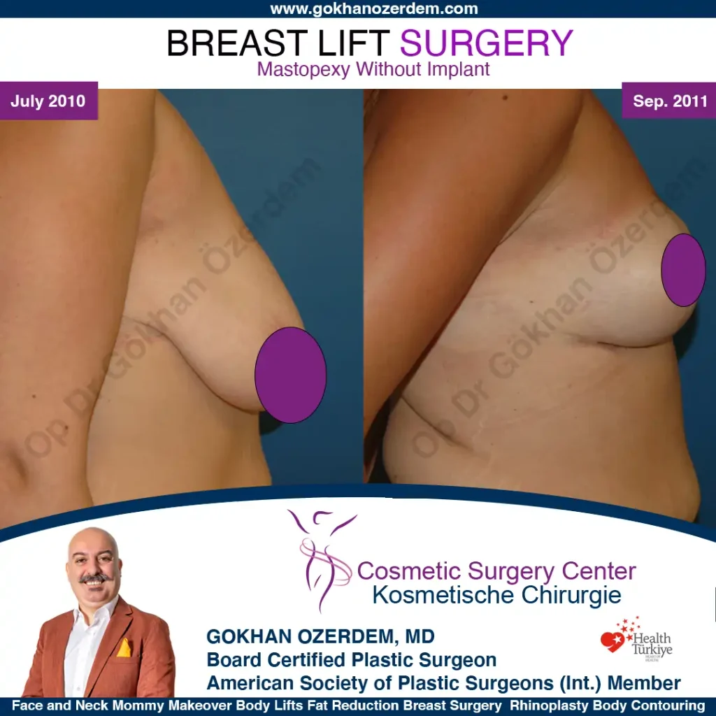 Breast Lift in Turkey, Case 23- Right Side