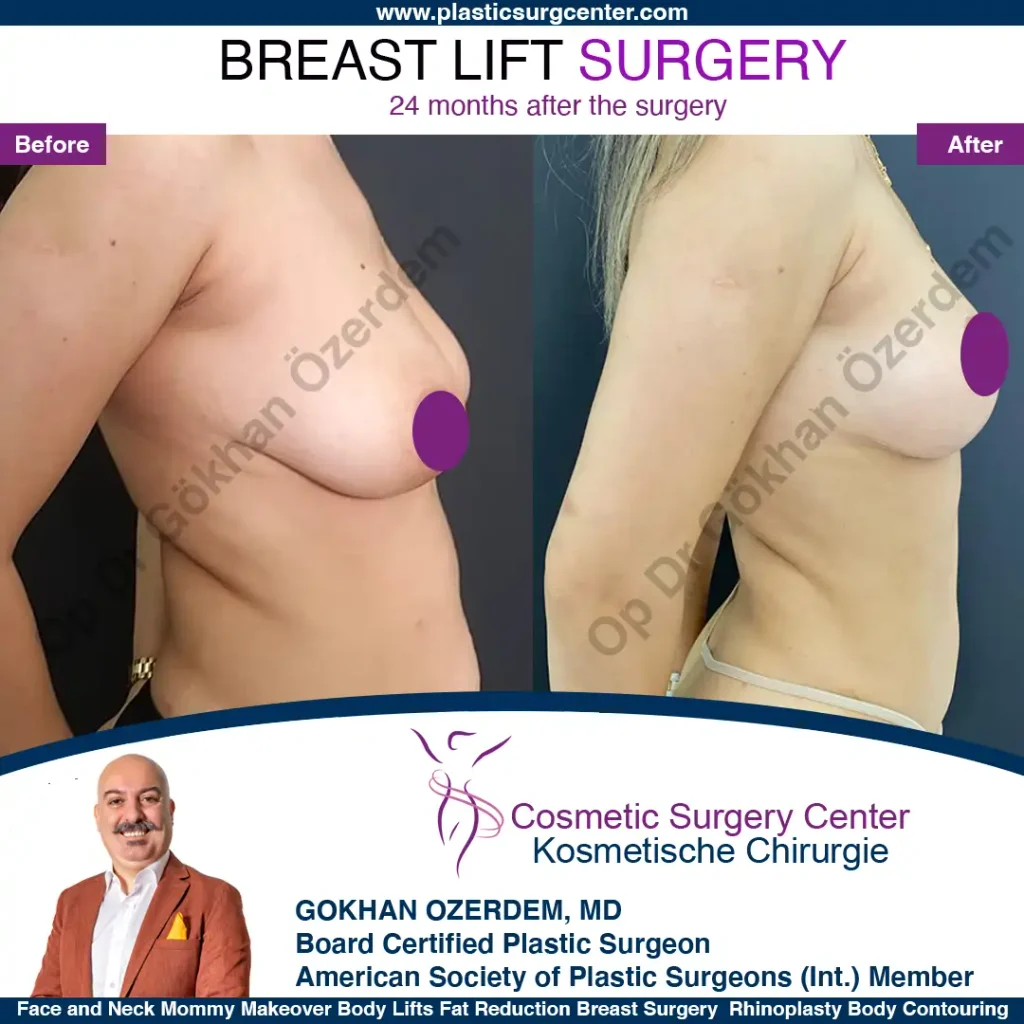 Breast Lift in Turkey, Case 9 - Right Oblique View