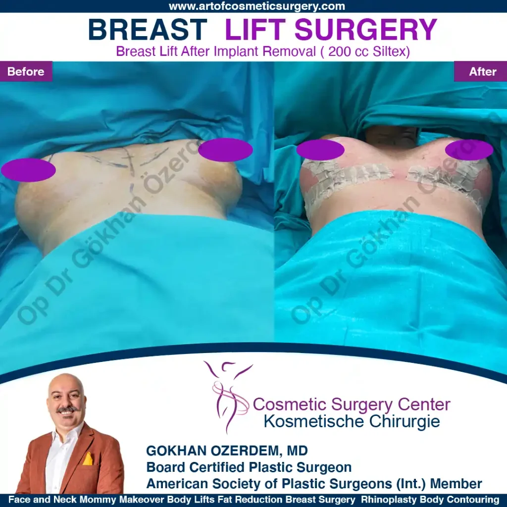 Breast Lift in Turkey, Case 22- Front Side - In the operation room
