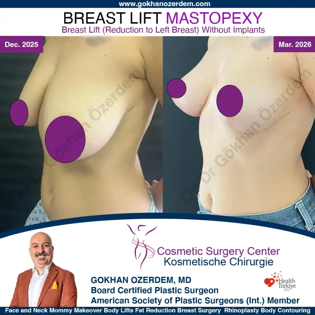 Breast Lift in Turkey, Case 8 - Left Oblique View