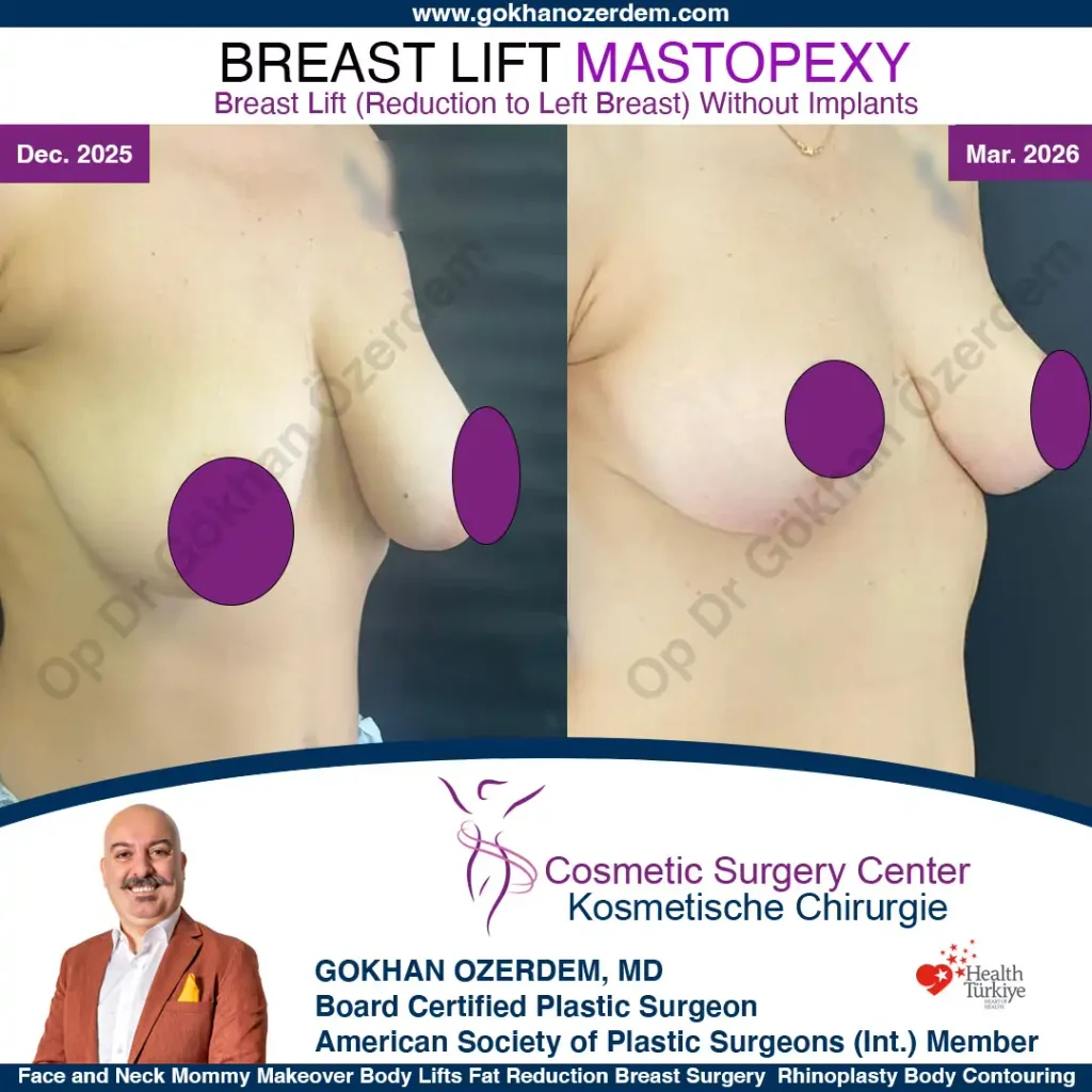 Breast Lift in Turkey, Case 8 - Right Oblique View