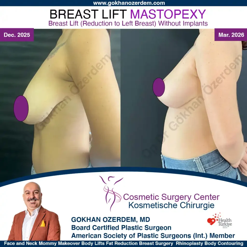 Breast Lift in Turkey, Case 8 - Left Side