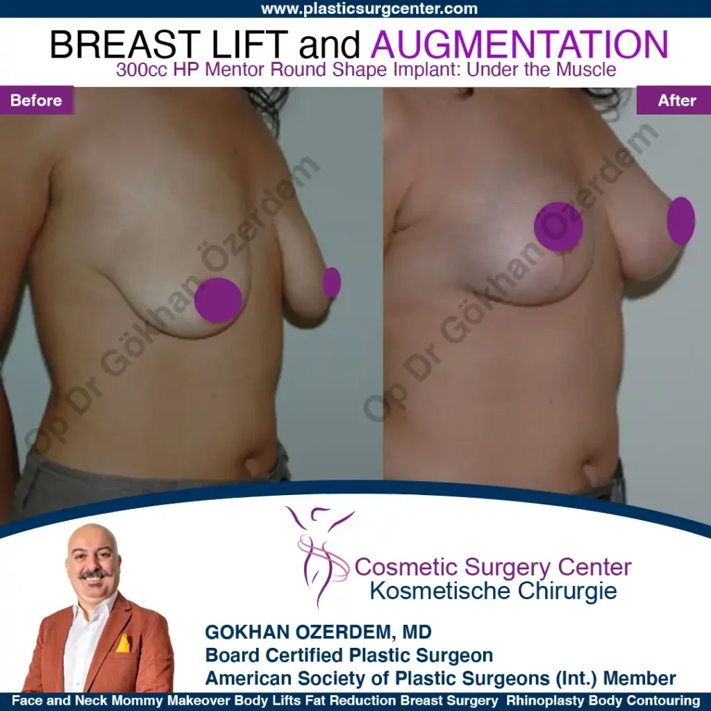 Breast Lift in Turkey, Case 5 - Oblique View - with implant