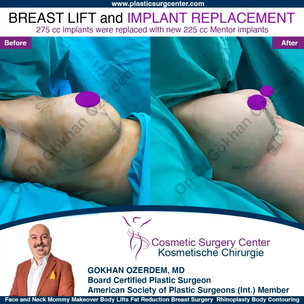 Breast Lift in Turkey, Case 19- Right Side - In the operation room