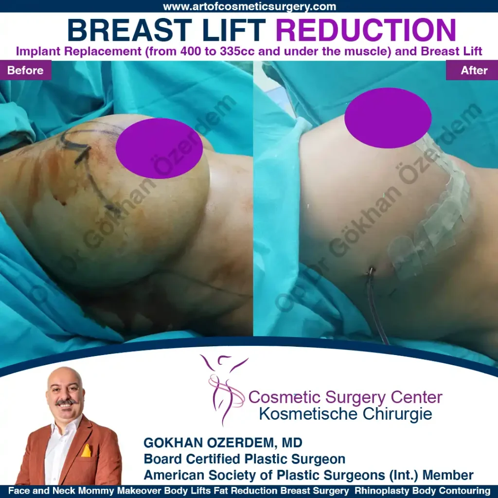 Breast Lift in Turkey, Case 20- Right Side - In the operation room
