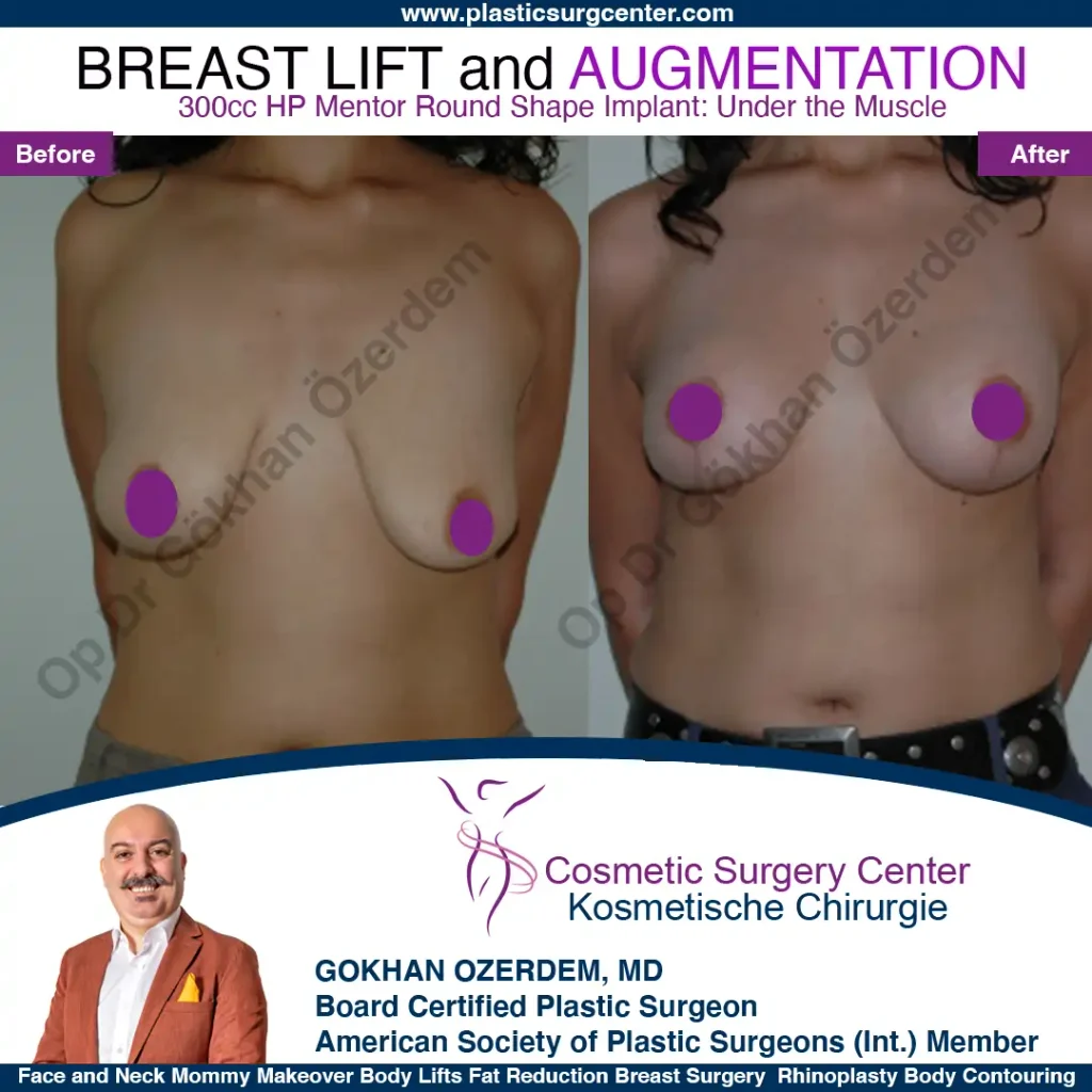 Breast Lift in Turkey, Case 5 - Front View - with implant