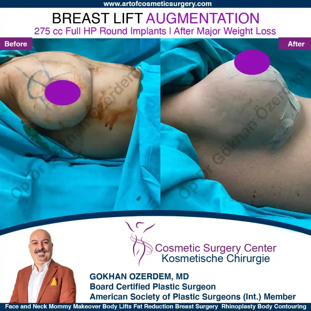 Breast Lift in Turkey, Case 18- Right Side - In the operation room