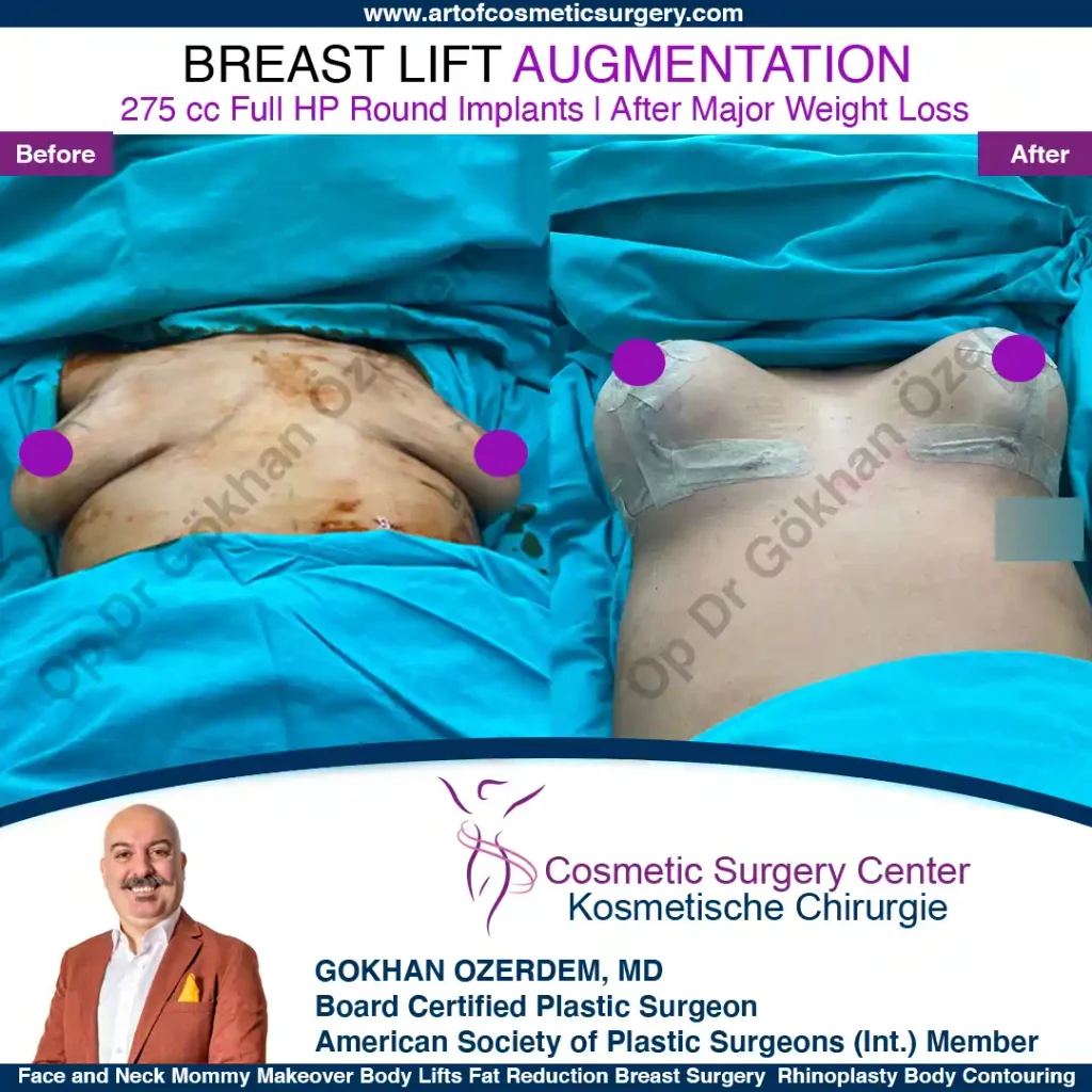 Breast Lift in Turkey, Case 17- Front Side - In the operation room