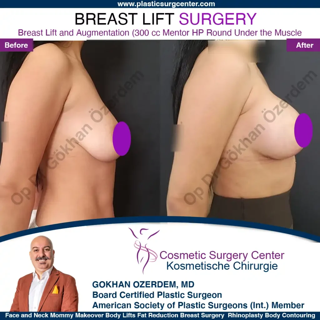 Breast Lift in Turkey, Case 6 - Right Side - with implant