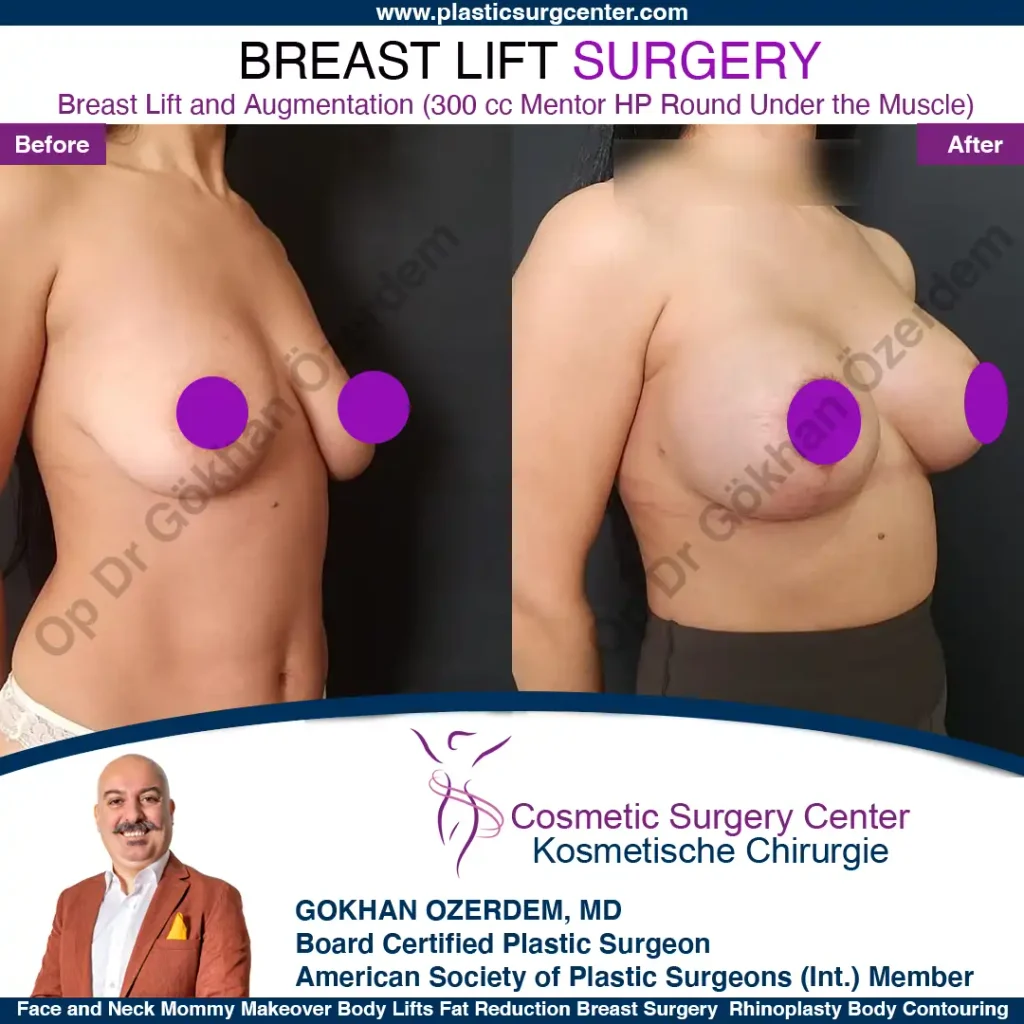Breast Lift in Turkey, Case 6 - Oblique View - with implant