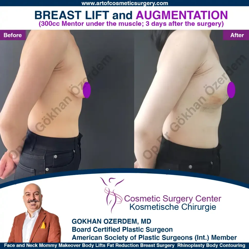 Breast Lift in Turkey, Case 7 - Right Side - with implant