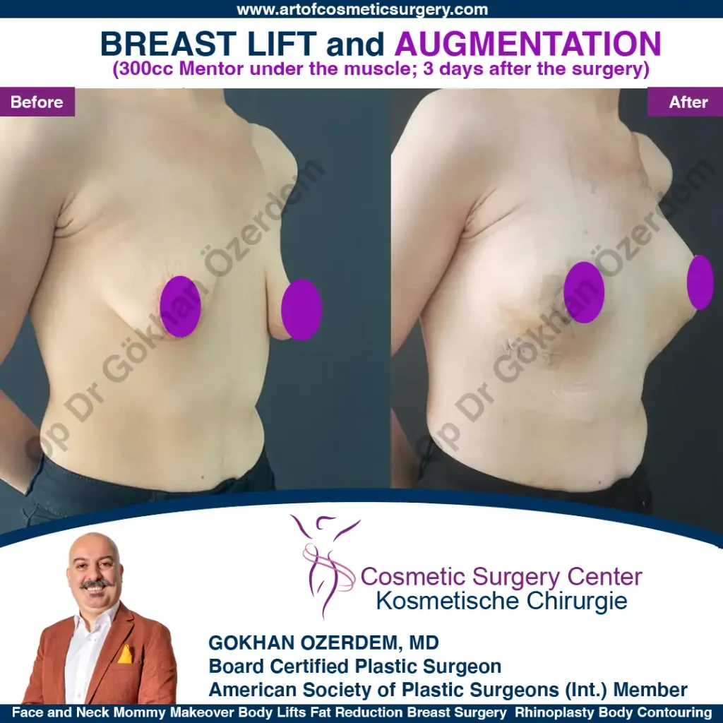 Breast Lift in Turkey, Case 7 - Right Oblique View - with implant