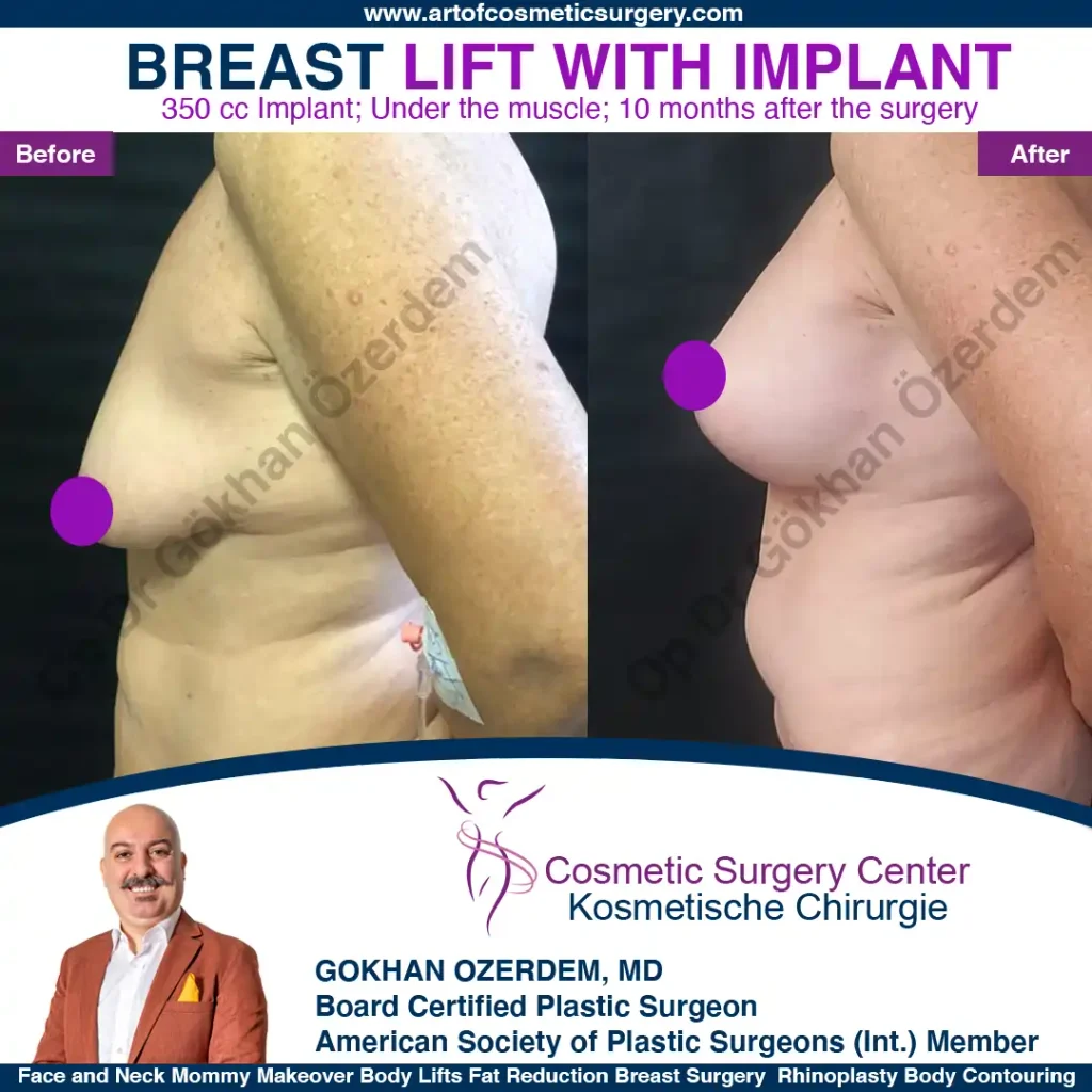 Breast Lift in Turkey, Case 4 - Left View - with implant