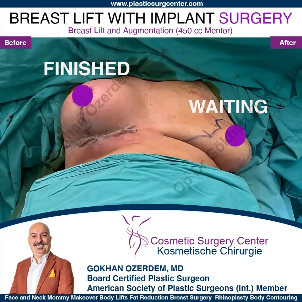 Breast Lift in Turkey, Case 15- Front Side - In the operation room
