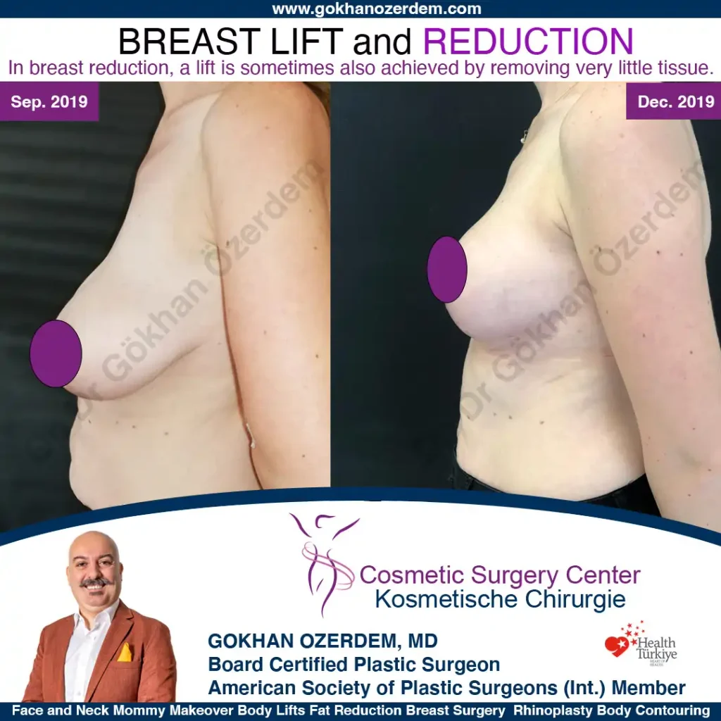 Breast Lift in Turkey, Case 2 - Left View
