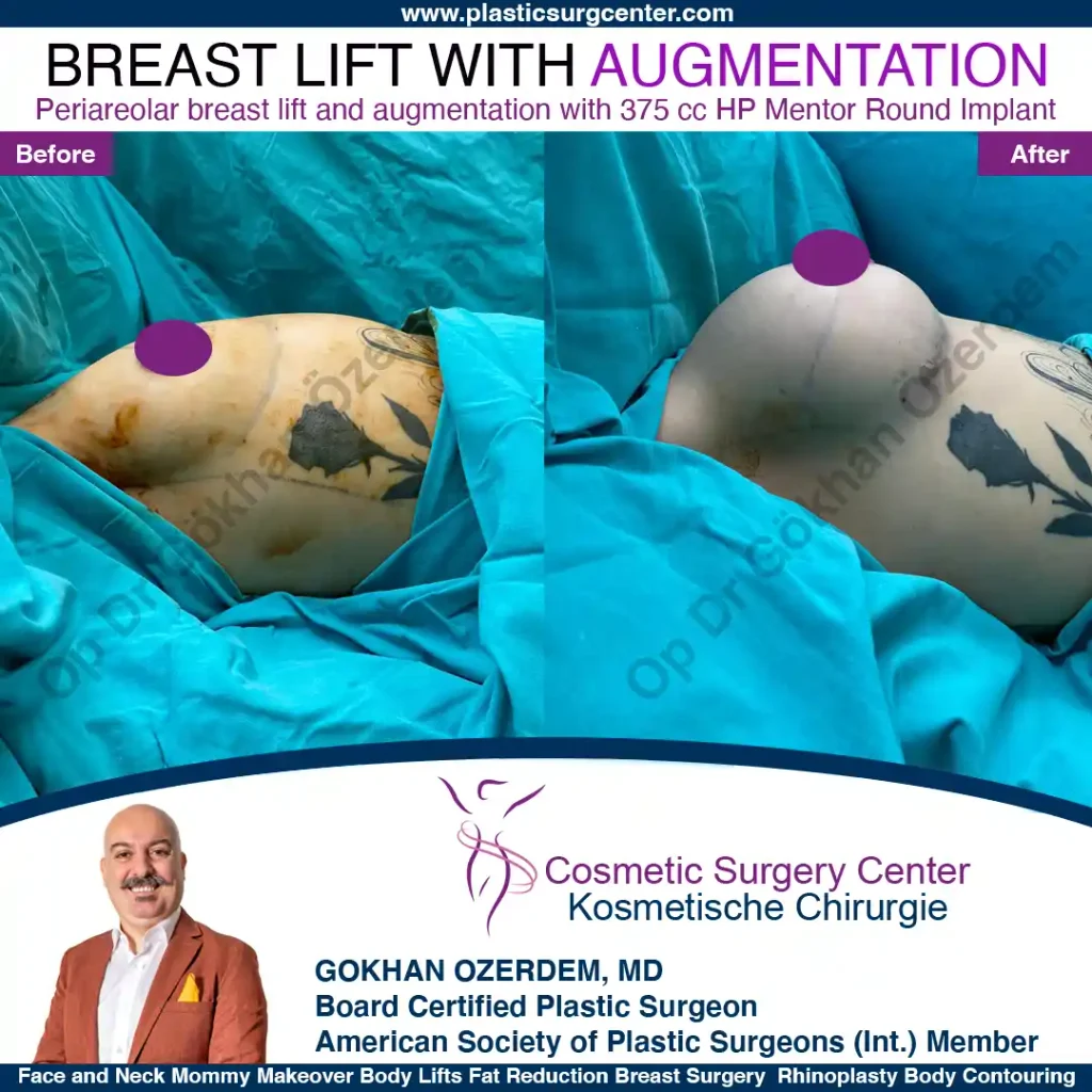 Breast Lift in Turkey, Case 12- Right Side - In the operation room