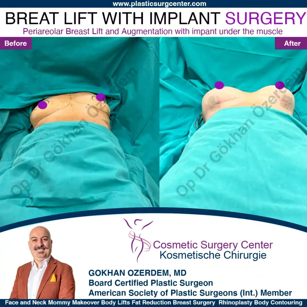 Breast Lift in Turkey, Case 13- Front Side - In the operation room