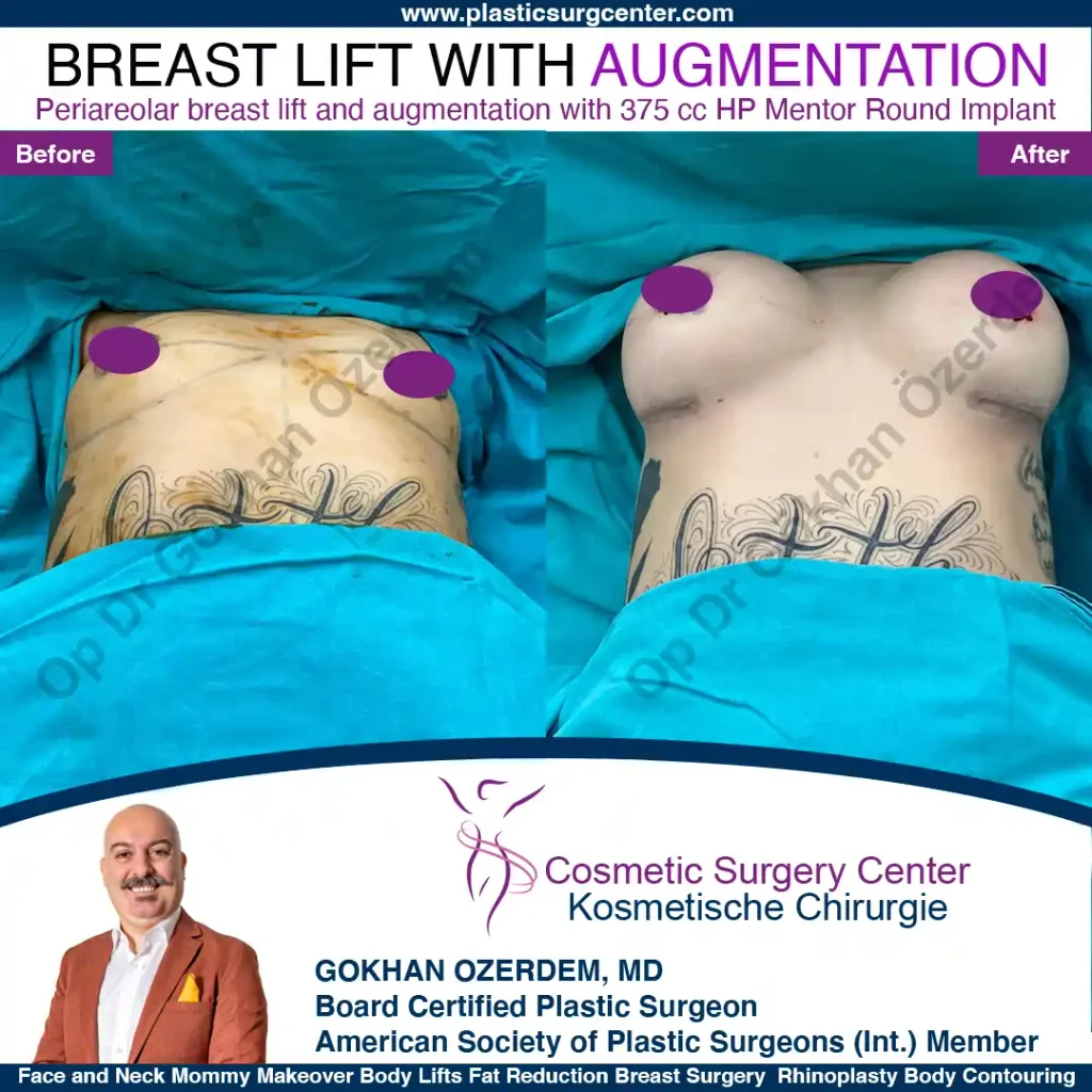 Breast Lift in Turkey, Case 12- Front Side - In the operation room