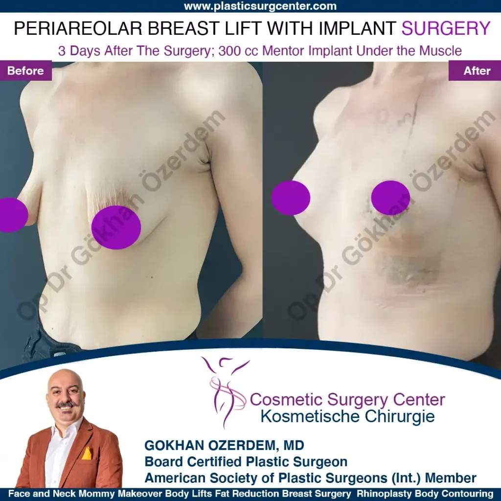 Breast Lift in Turkey, Case 7 - Left Oblique View - with implant
