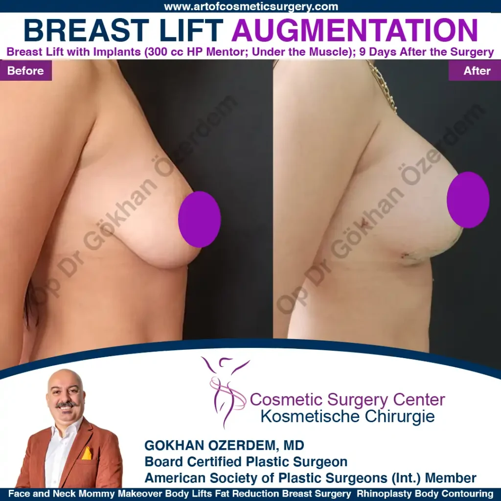 Breast Lift in Turkey, Case 3 - Right View